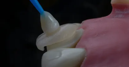 Slika za članak: Kompozitne fasete