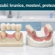 Veštački zubi: krunice, mostovi, proteze i implanti recent post image